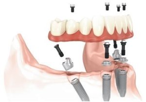 implant replacement illustration