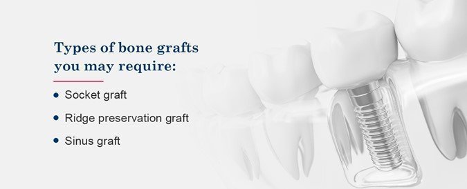 Bone grafting infographic
