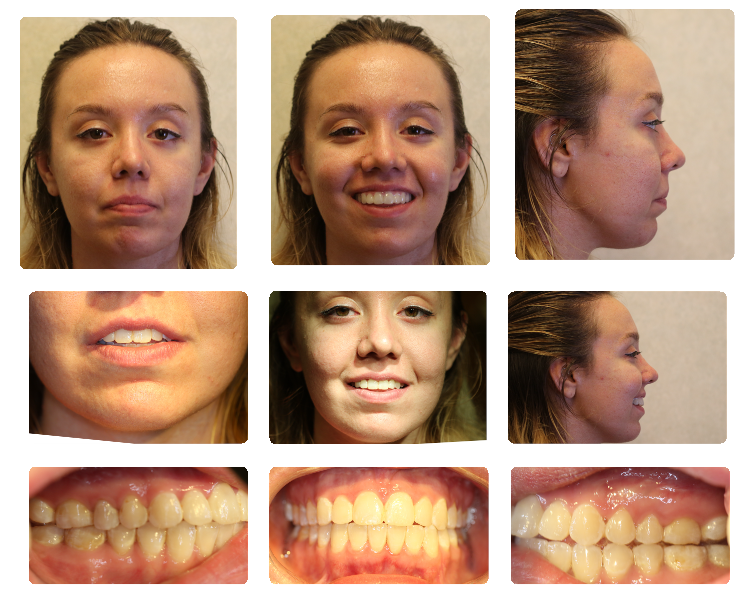 TMJ Replacement Surgery case study