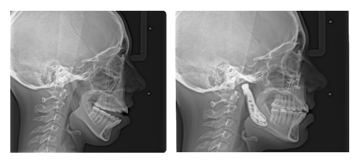 TMJ Replacement Surgery case study xray